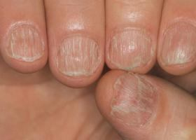 Почему появляются белые пятна на ногтях пальцев рук