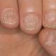 Почему появляются белые пятна на ногтях пальцев рук