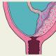 Понятие низкой плацентации при беременности: что это значит и чем грозит такое расположение плаценты?